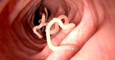 Die Ursachen von Parasiten im menschlichen Körper