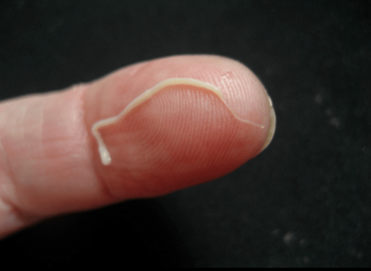 Nematodenparasiten aus dem menschlichen Körper